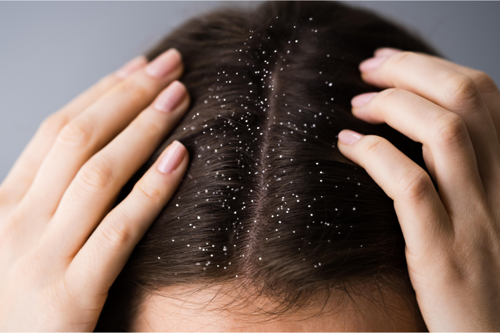 Dandruff and itchy scalp
