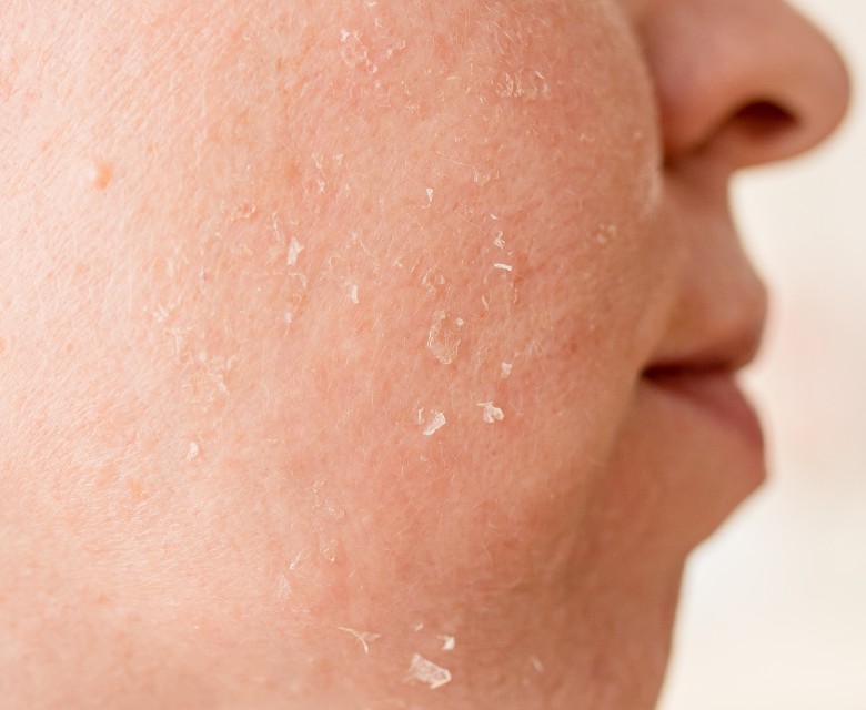 Dry and rough skin
